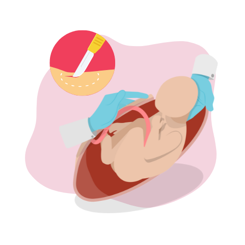 cesarskie-ciecie-proces-opieki-polozniczej