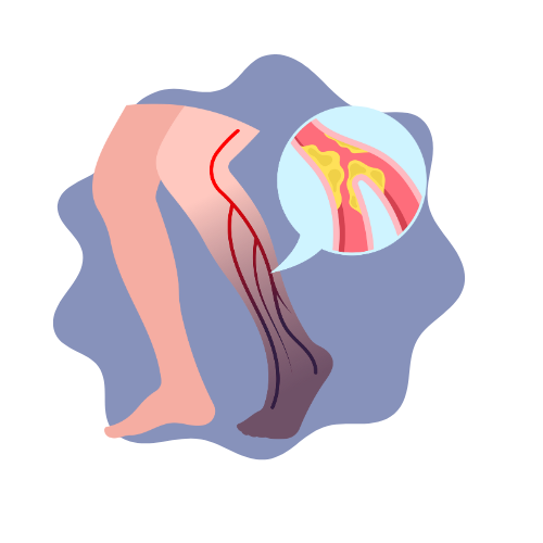 ostre-niedokrwienie-konczyn-dolnych-proces-pielegnowania